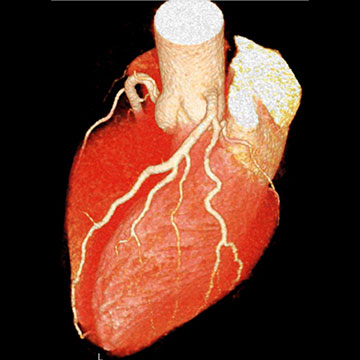 冠動脈CT 検査画像