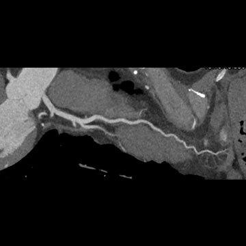 冠動脈CT 検査画像