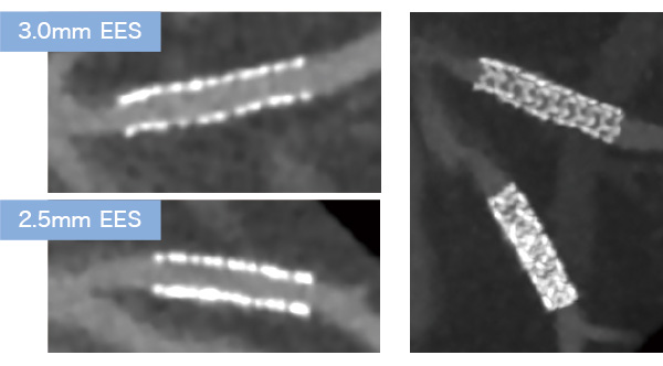 Mri ステント