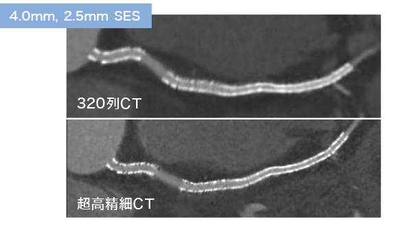 ステント mri