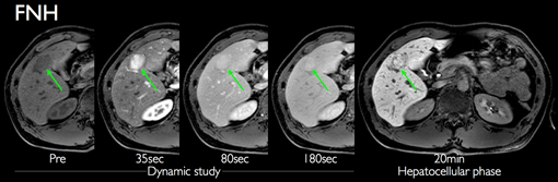 がんの早期発見を目的とする検査 肝臓がん（EOB・プリモビスト）、膵臓 