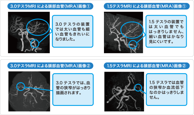 MRIの画像の比較