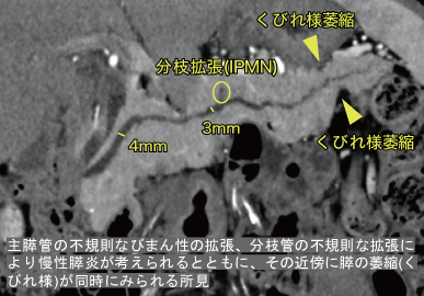 膵石灰化(慢性膵炎・膵石)- AIC八重洲クリニック(東京・茨城)