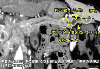 超希少石】膵結石超希少な膵結石膵石スイセキ人体石標本資料 超希少石】膵結石超希少な膵結石膵石スイセキ人体石標本資料
